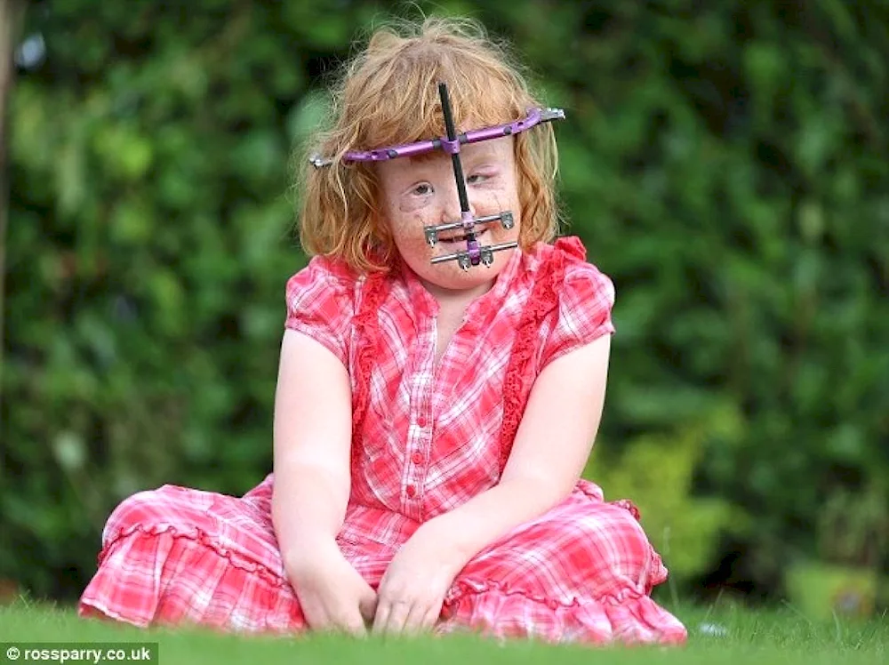 Acrocephalosyndactyly Apert's syndrome