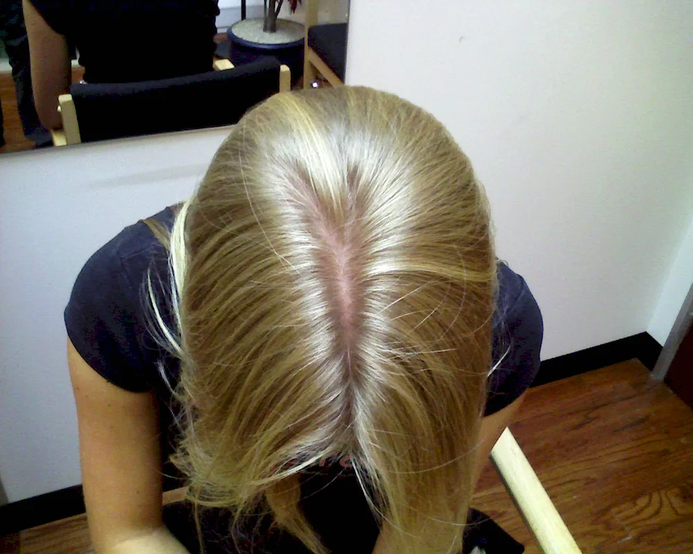 Alopecia Propecia