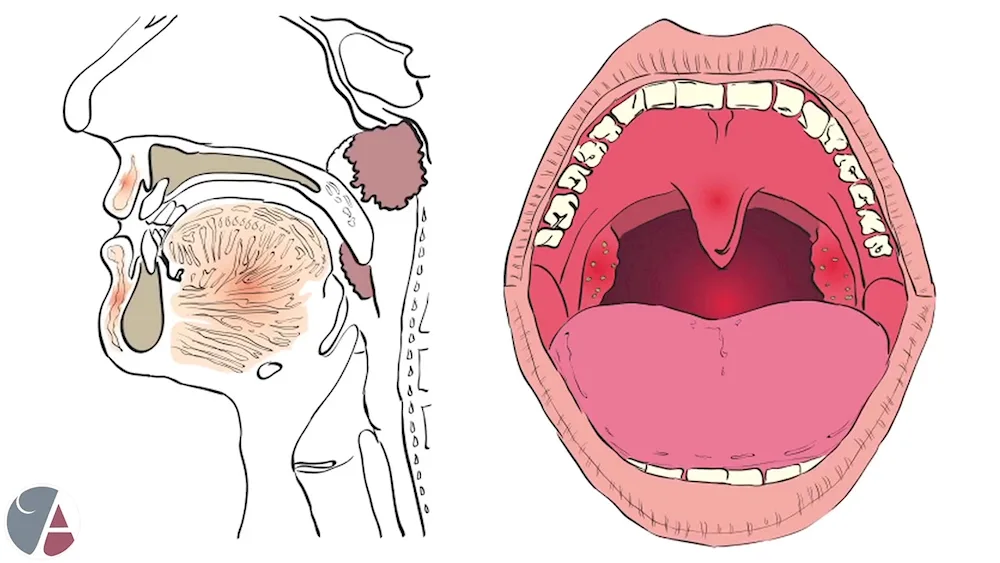 Anatomy of the nasopharynx adenoids