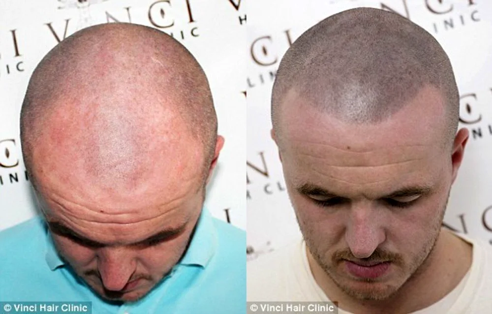 Andrey Afanasiev trichopigmentation