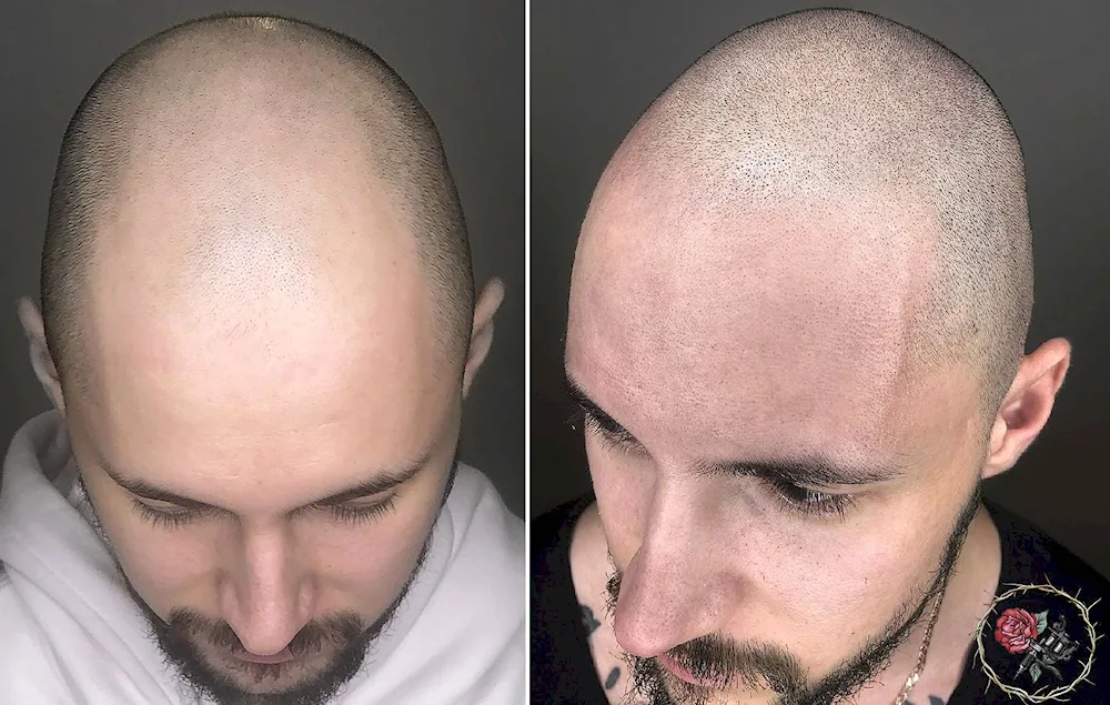 Andrey Afanasiev trichopigmentation