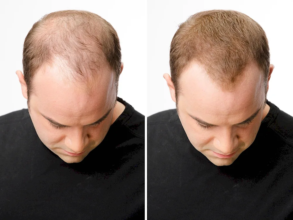 Androgenic Alopecia Hamilton