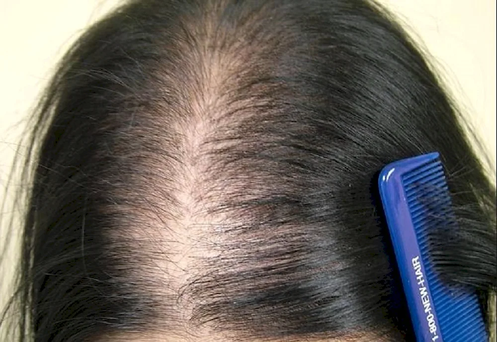 Mesotherapy for hair