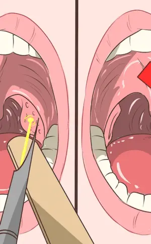 Angina of the palatine tonsils