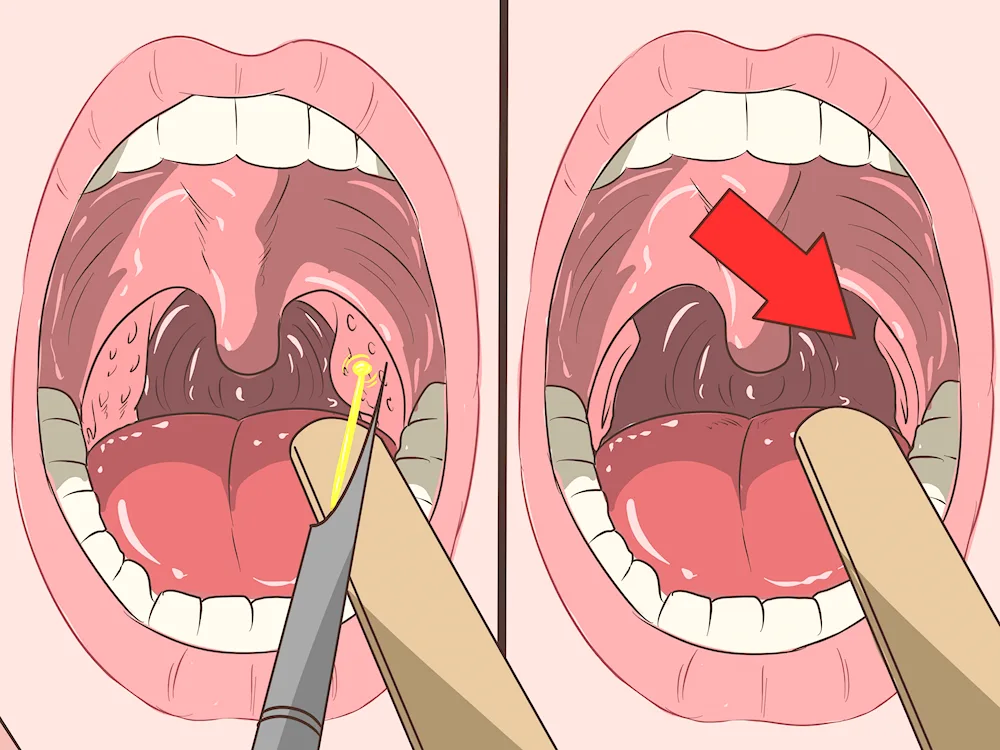 Angina of the palatine tonsils