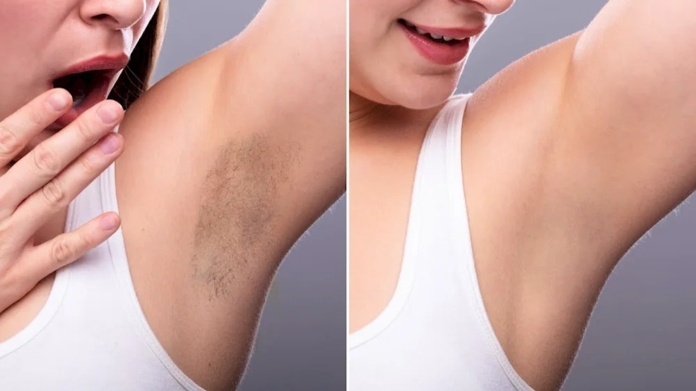 White armpits