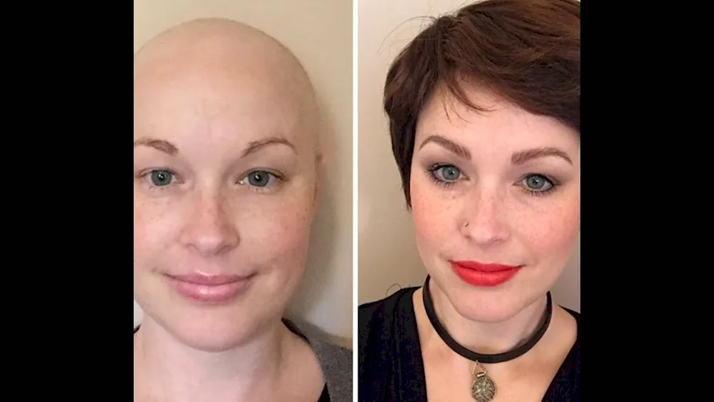 Short haircuts after chemotherapy