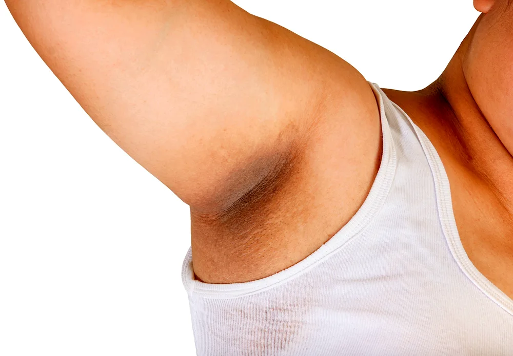 Hydradenitis in the armpit