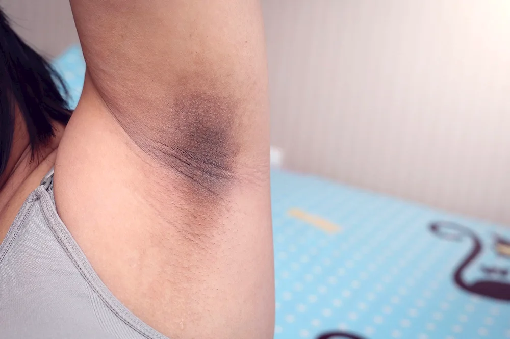 Black armpit acanthosis