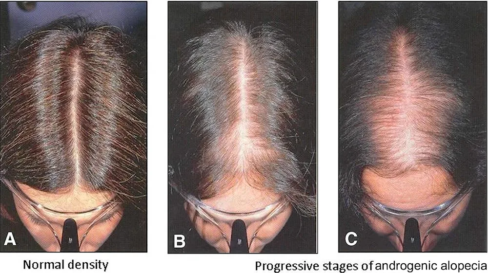 Darsonval androgenic alopecia dansonval haircuts