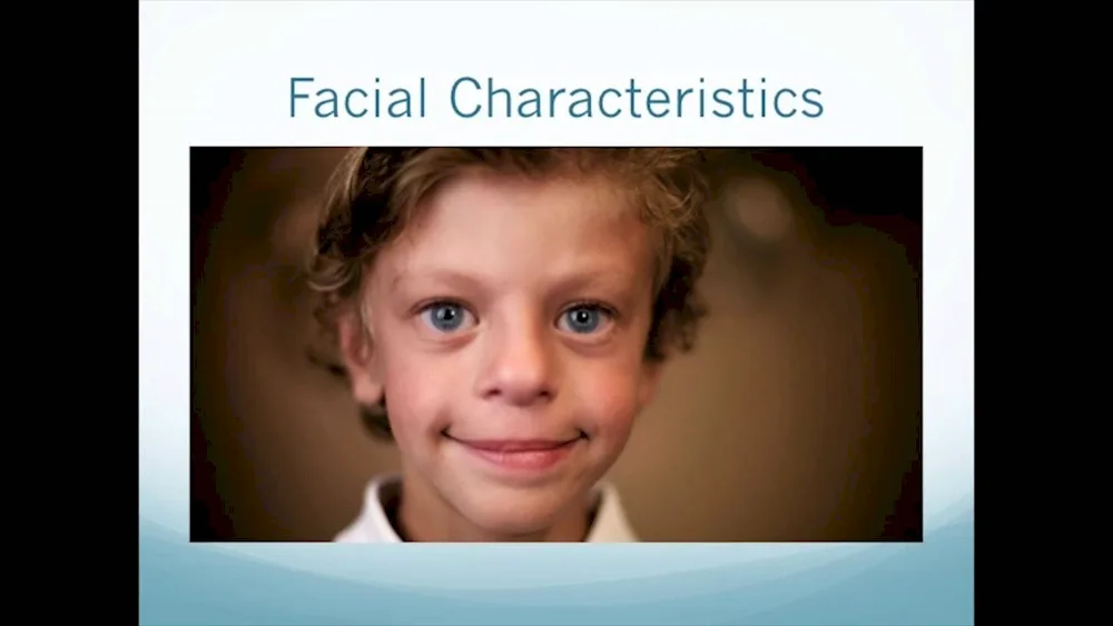 Children elves Williams syndrome