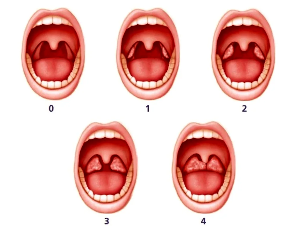 Follicular tonsil sore throat