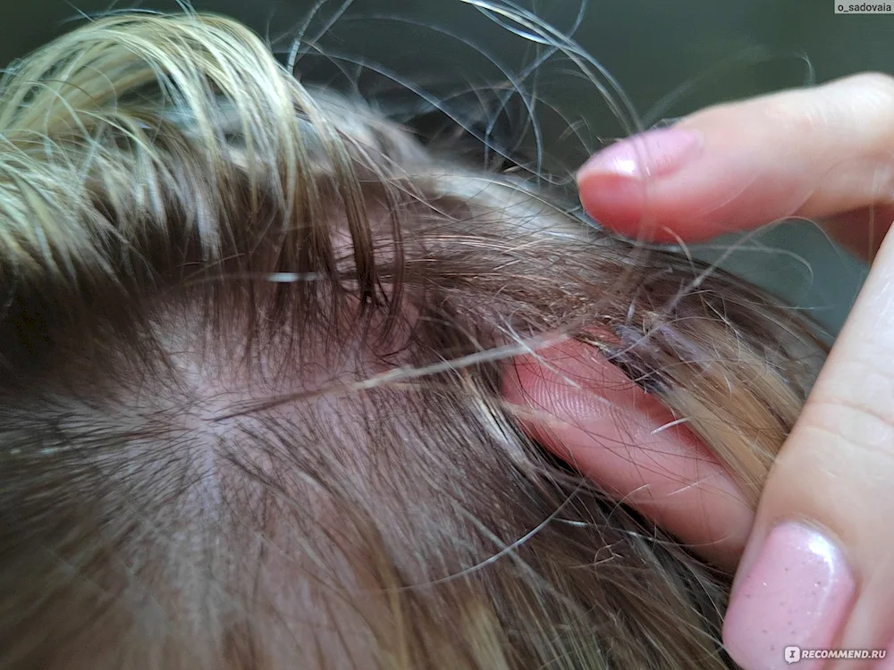 Photos after removing hair extensions