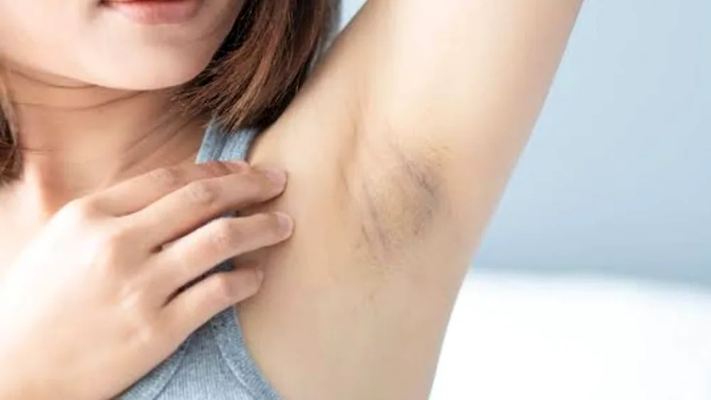 Hyperpigmentation of armpit skin