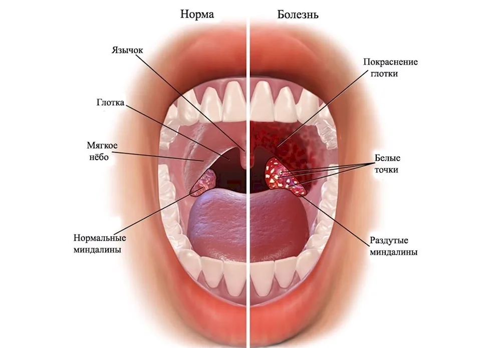 Glandular pharyngitis