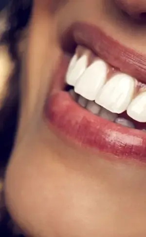 Hollywood smile veneers