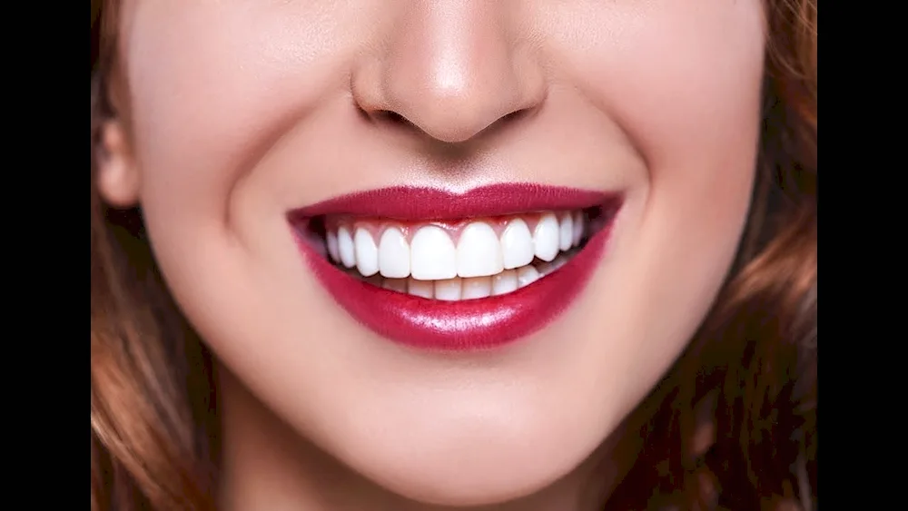 Hollywood smile veneers