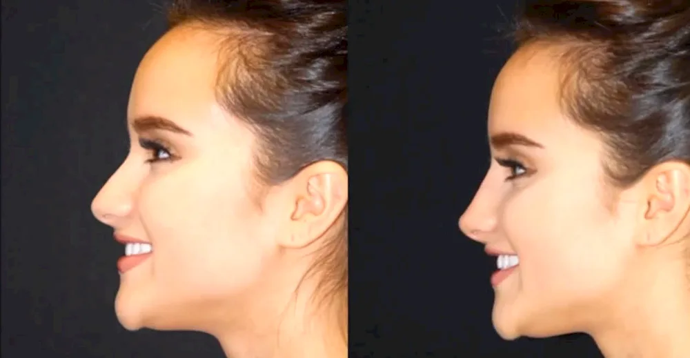 Ideal nose