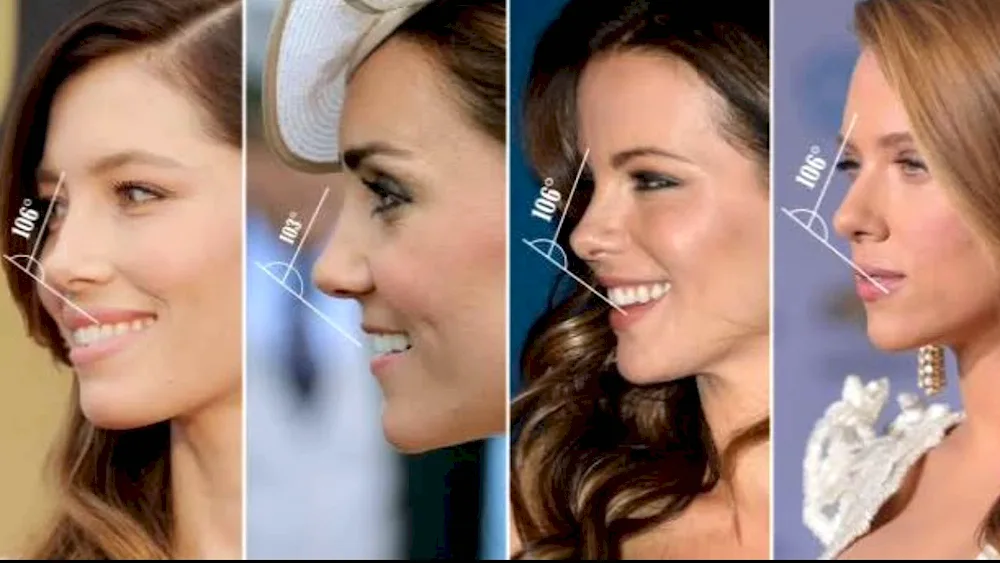 Rhinoplasty. big humped nose