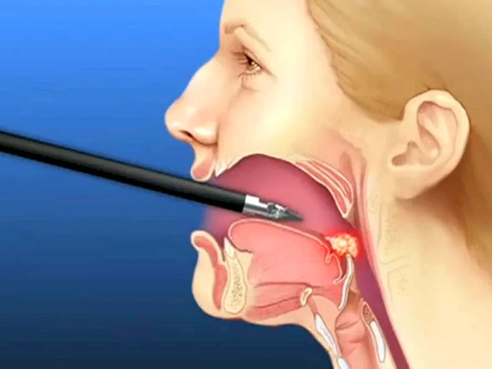 Cold plasma tonsillectomy