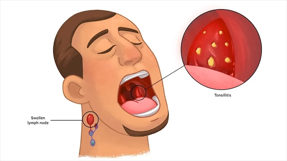 Chronic tonsillitis symptoms tonsillitis symptoms