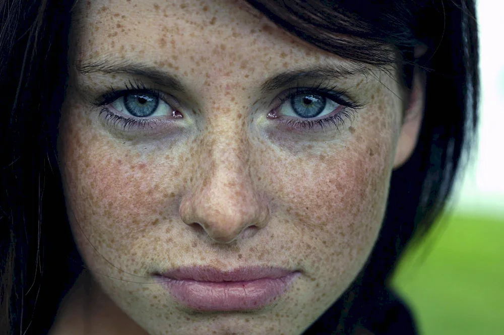 Emma Stone freckles