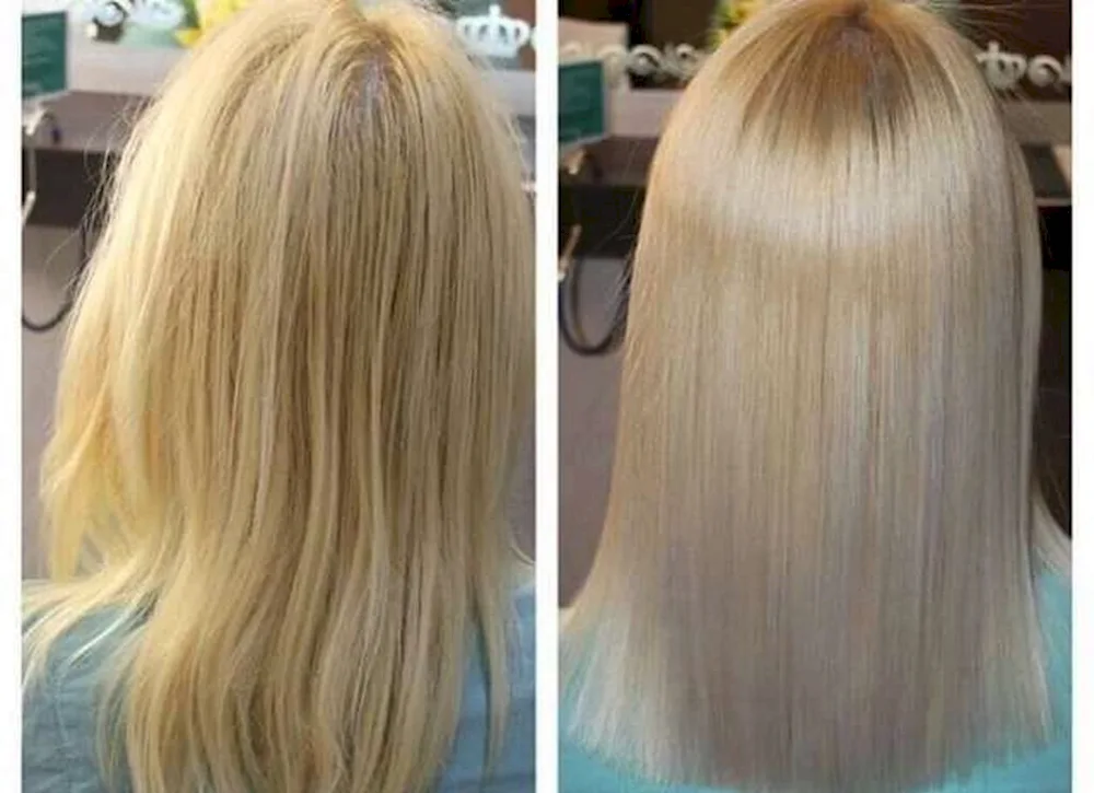 Botox before and after