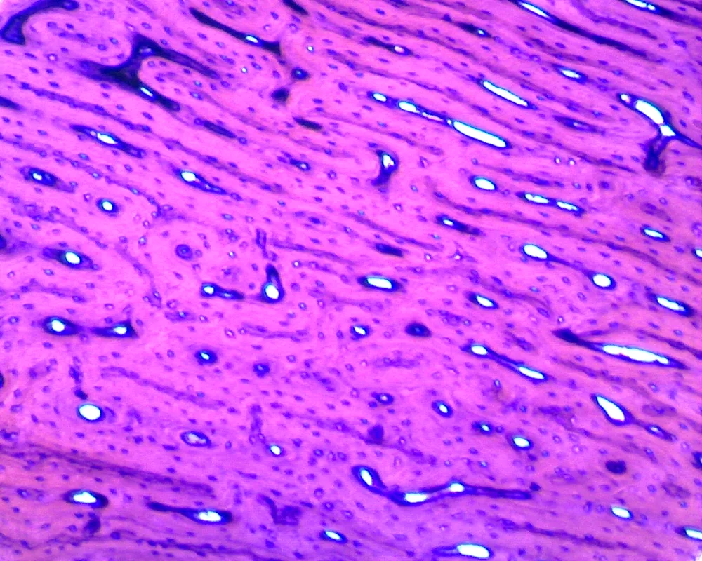 Metalloconiosis histology