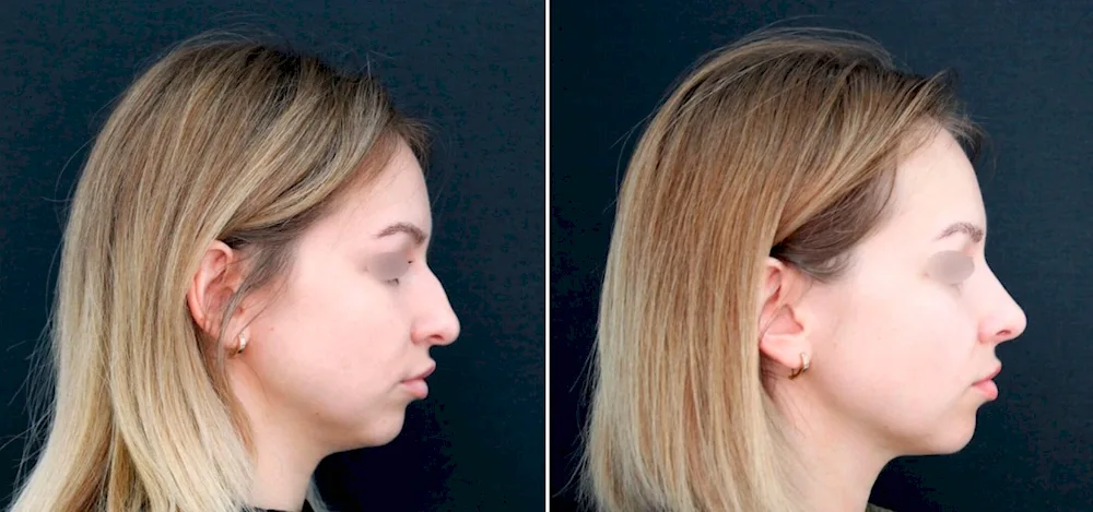 Girl's nose with a slight hump