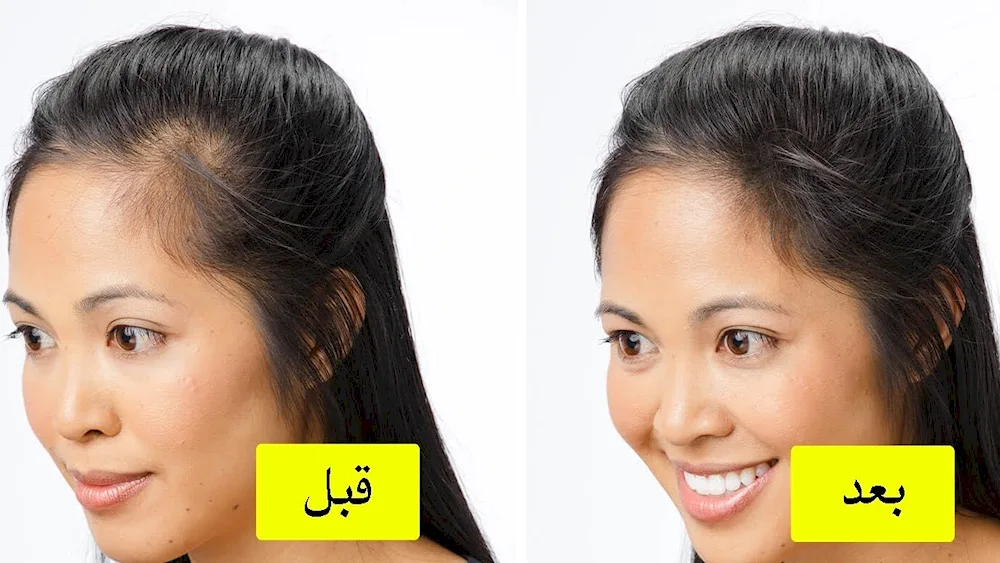 Lob with bald spots hairstyle for balding women