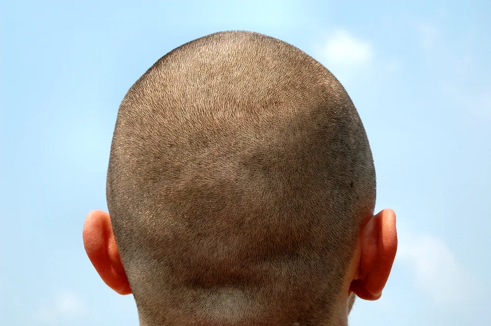 Bald men's head