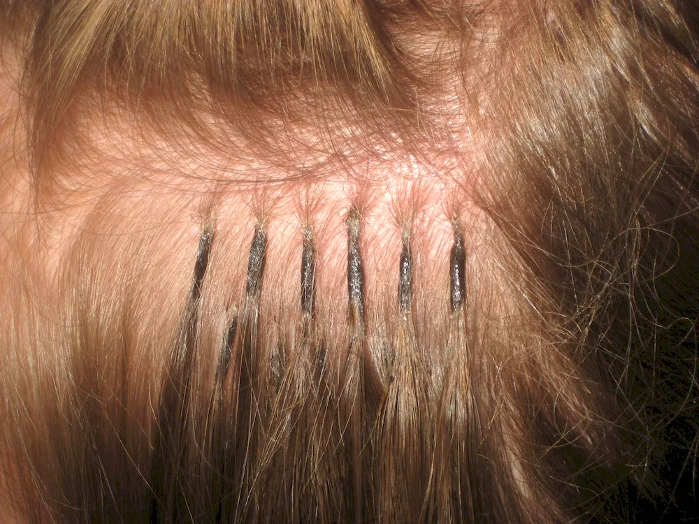 Hair extensions horrors