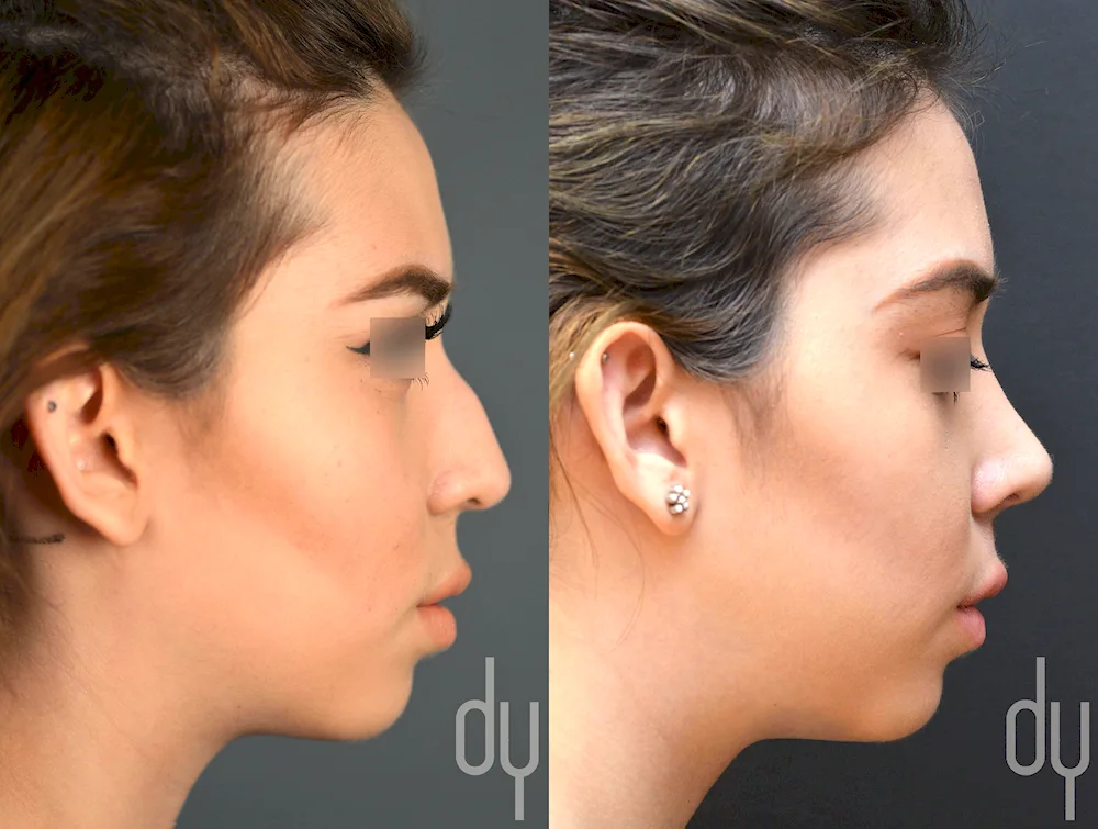 Julia Franz rhinoplasty