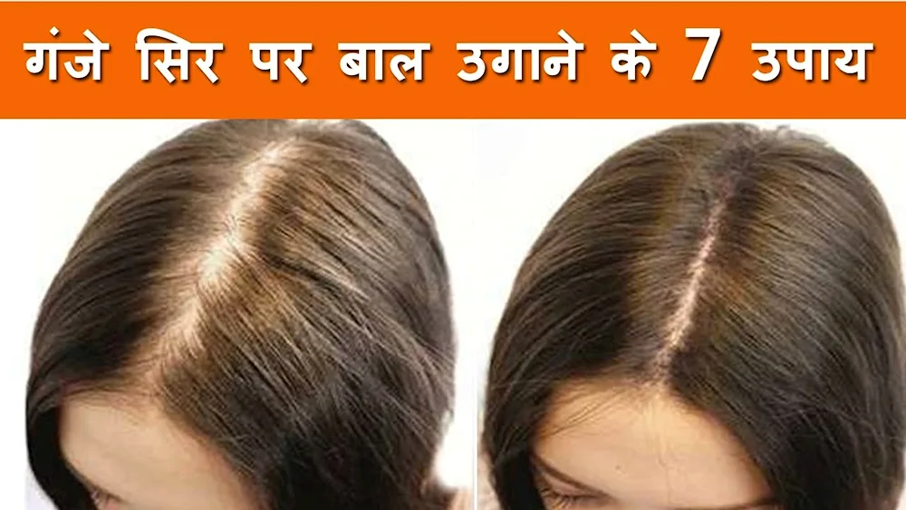 Mesotherapy hair before and after