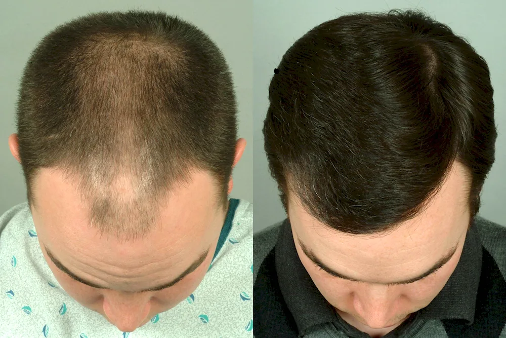 Minoxidil alerana effect