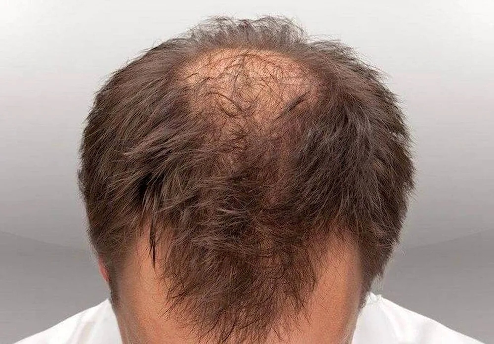 Hairstyles with baldness