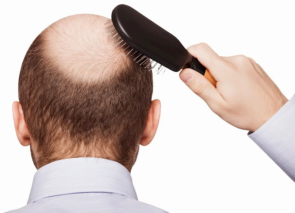 Long hair bald