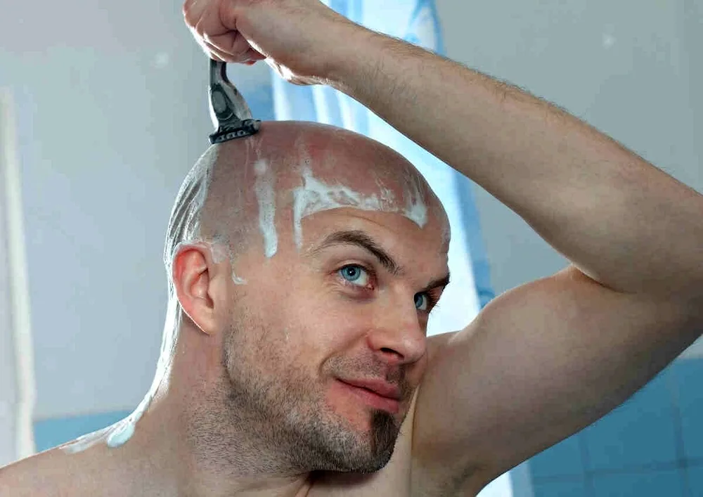 Male baldness