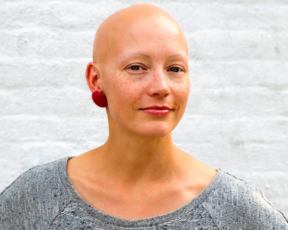 Natasha Whiteman bald