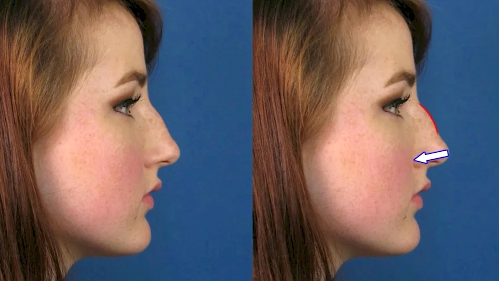 Humpy nose rhinoplasty