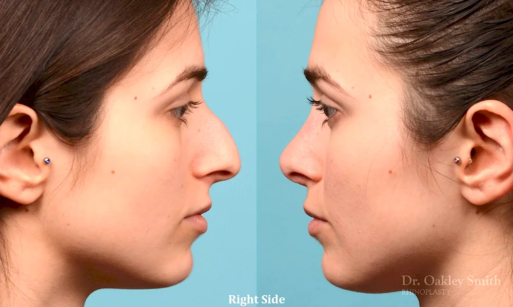 Haibula Kamilovic rhinoplasty