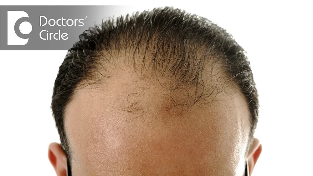 Trichopigmentation scars