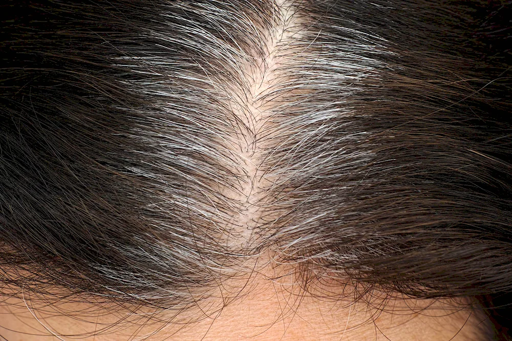 Focal Grey hair