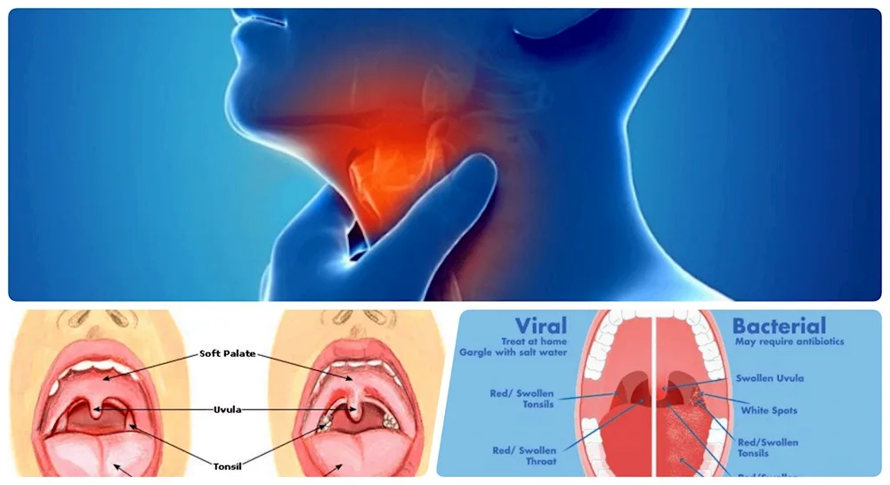 Acute chronic tonsillitis