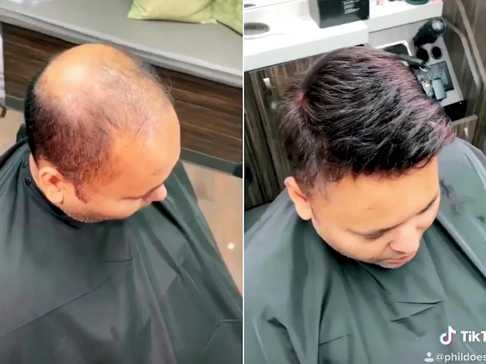 Hairstyles with baldness on foreheads men's