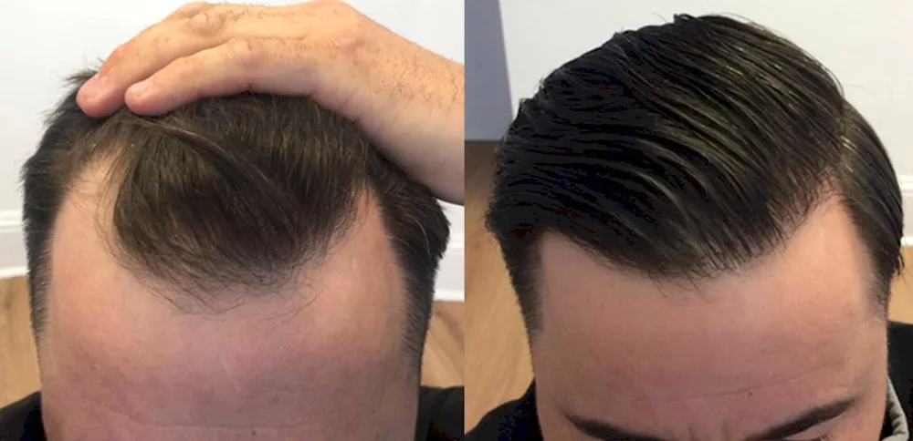 Men's hairstyles with baldness