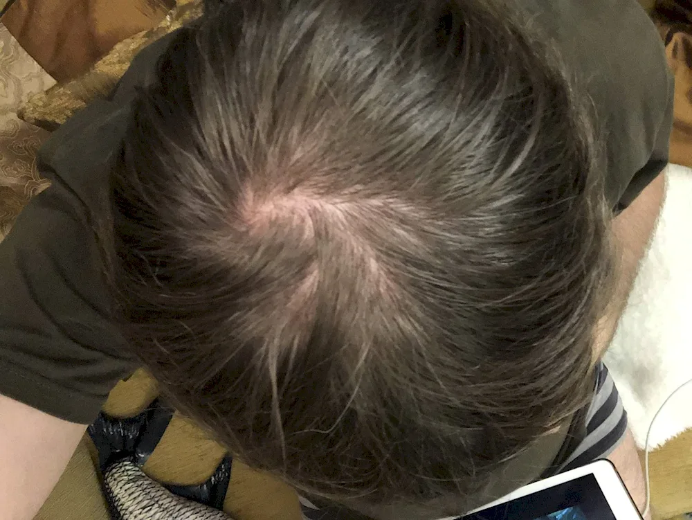 Alopecia Areata