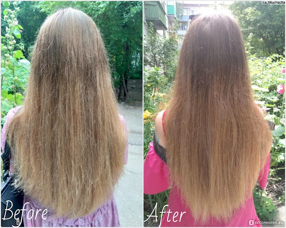 Botox for greasy hair