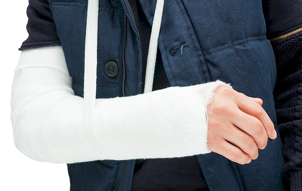 Bandage on the elbow with a fracture