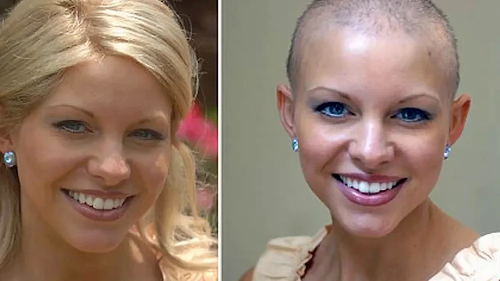 Hair cut after chemotherapy